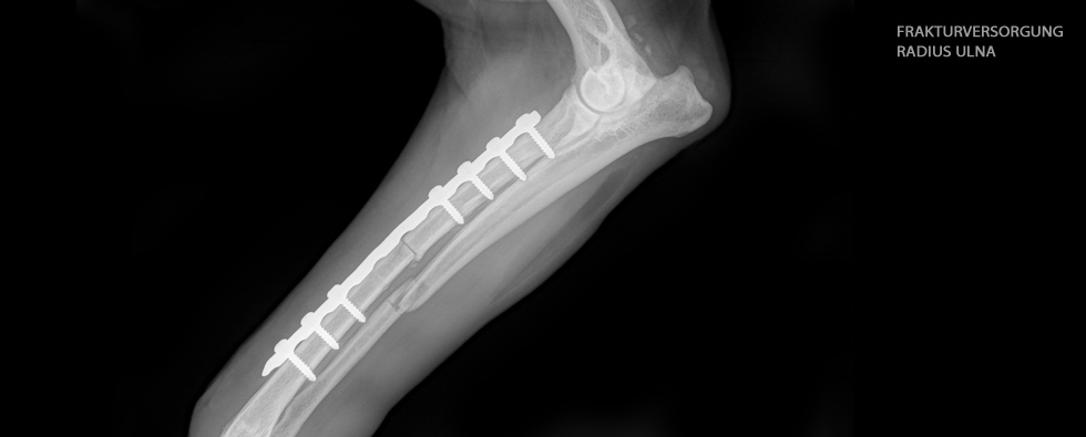 Frakturversorgung Radius Ulna
